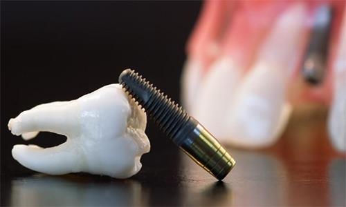 در چه مواردی از ایمپلنت دندانی استفاده می شود؟
